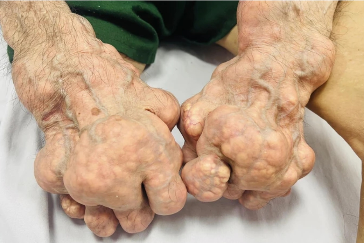 bệnh gout là gì