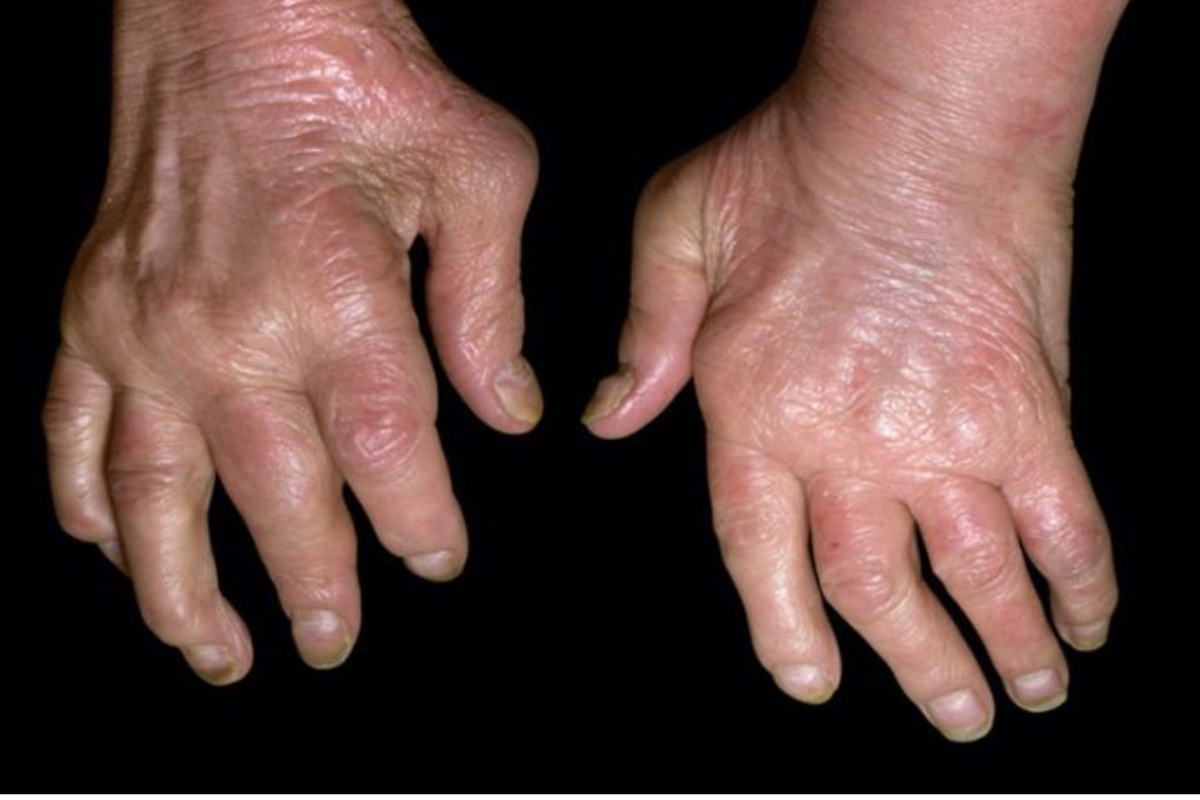 Biến chứng nguy hiểm của bệnh gout