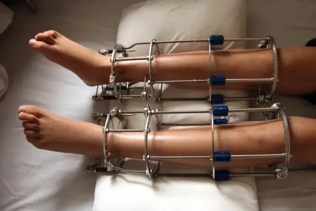 điều trị chênh lệch chi