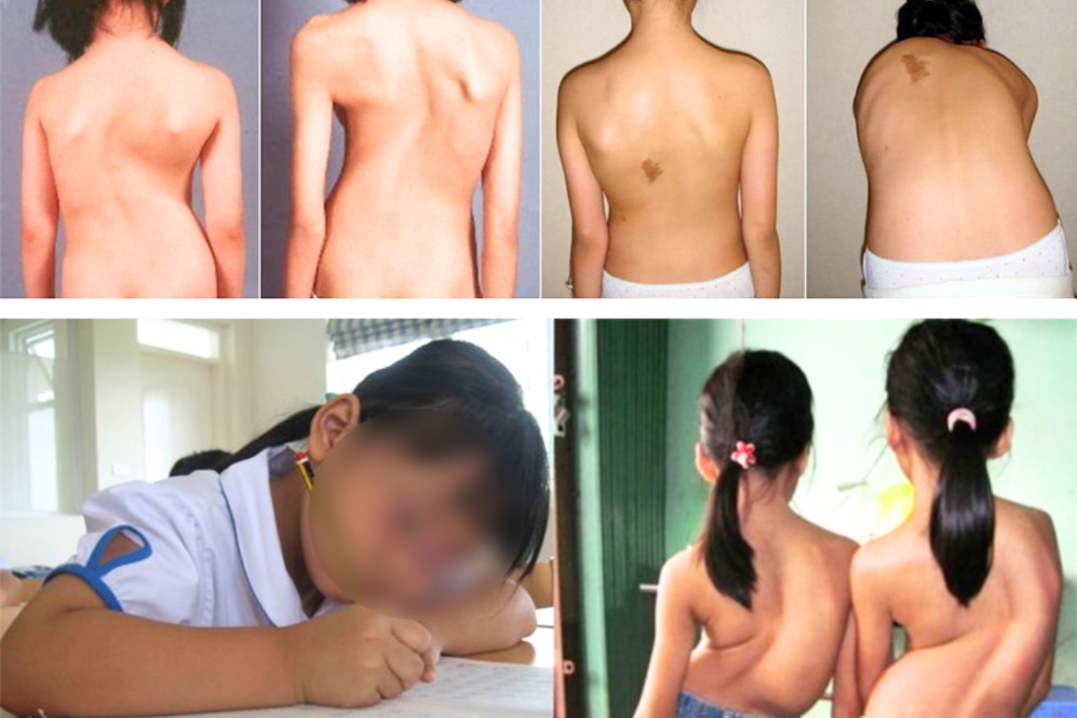Dấu hiệu nhận biết hội chứng Noonan