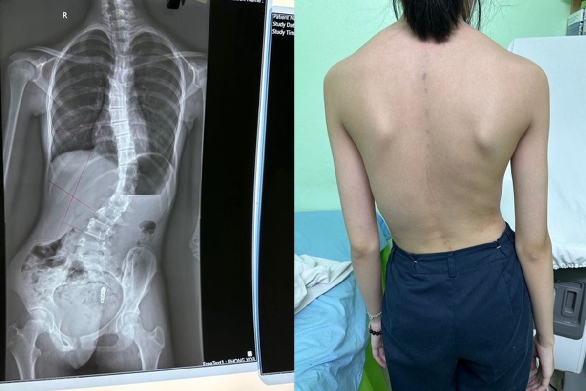 Dấu hiệu vẹo cột sống qua quan sát
