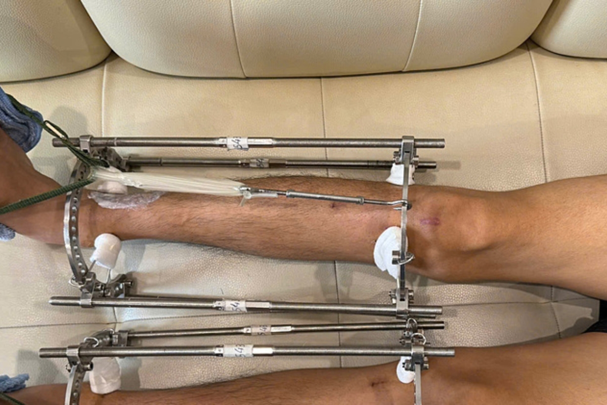 Điều kiện được thực hiện phẫu thuật kéo dài chân