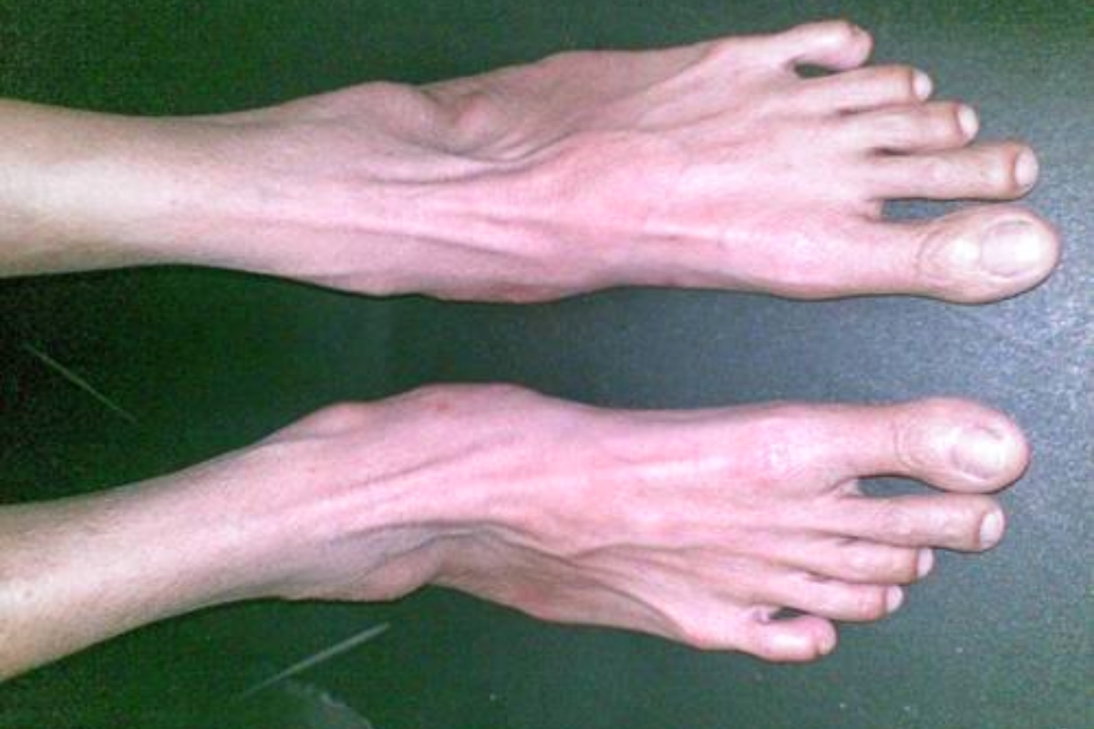 Hội chứng Marfan - Rối loạn di truyền ảnh hưởng đến mô liên kết trong cơ thể