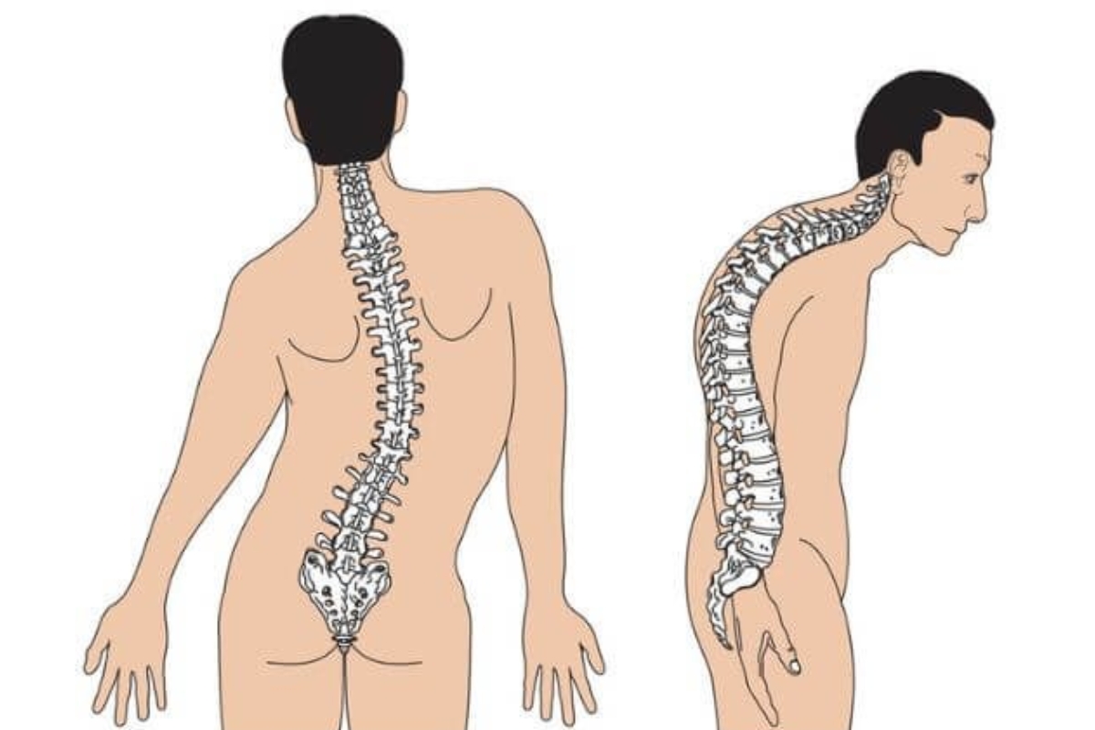 phương pháp chẩn đoán hội chứng marfan