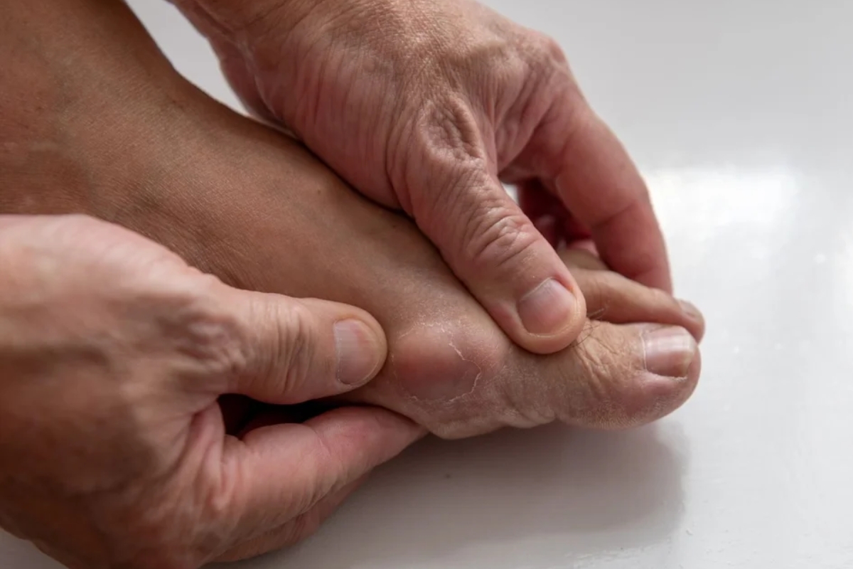 triệu chứng lâm sàng của gút