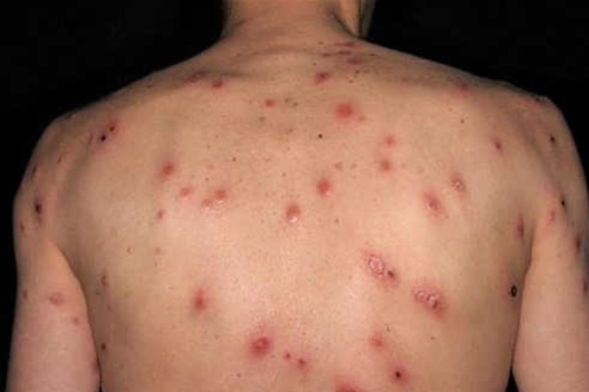 bệnh lậu là gì