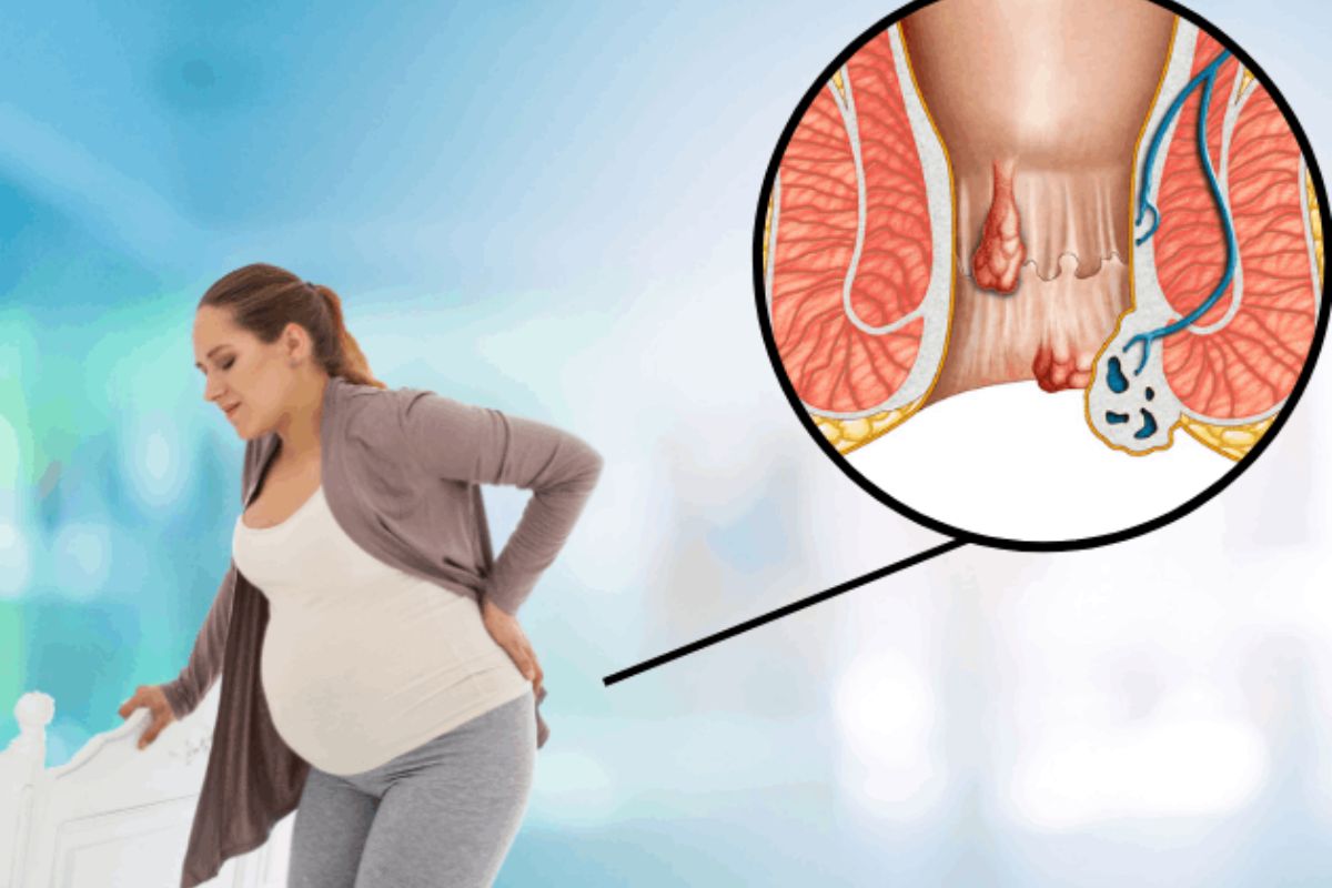 điều trị trĩ ngoại cho phụ nữ mang thai
