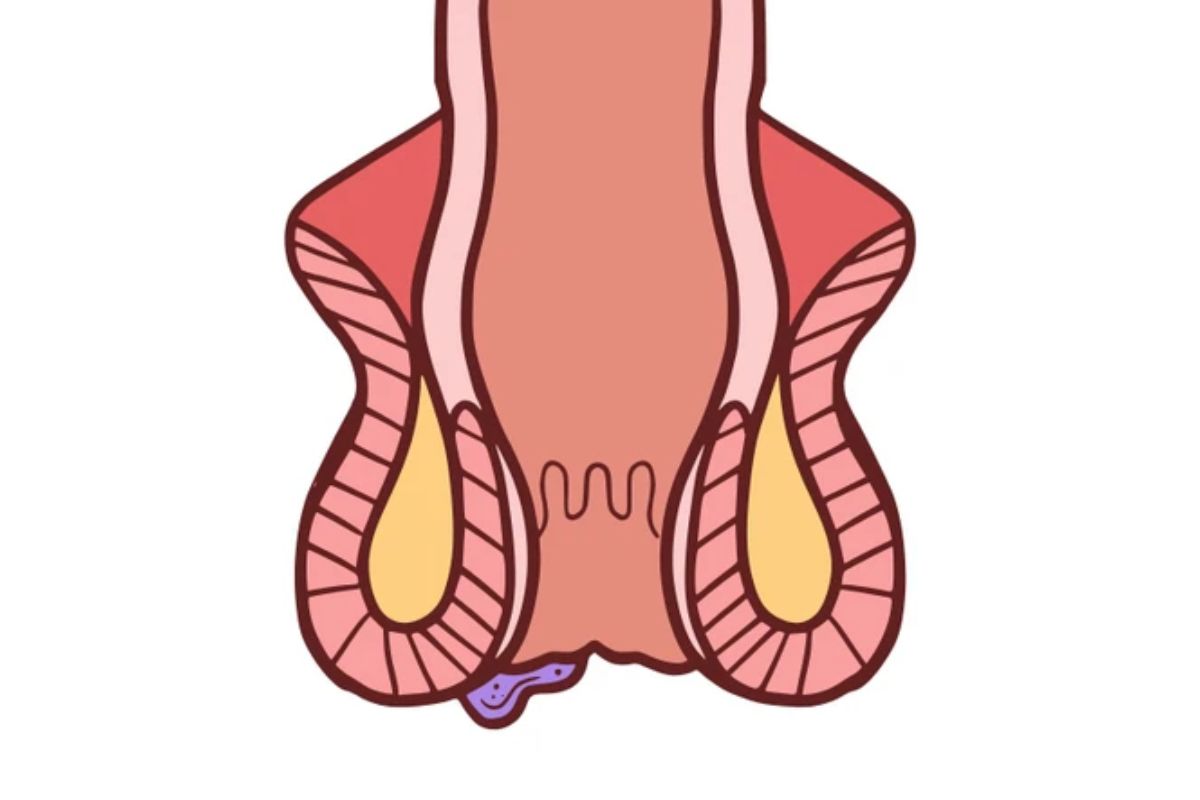 trĩ ngoại là bệnh gì