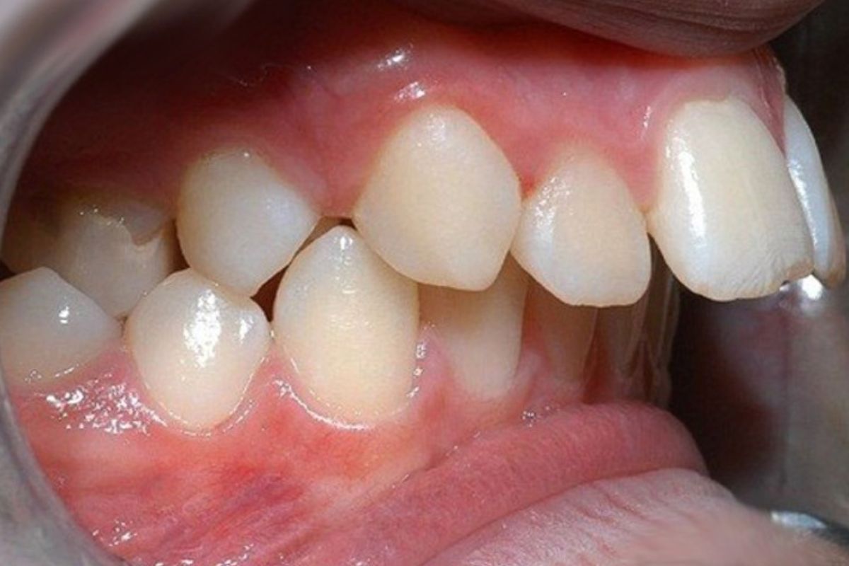 ảnh hưởng của răng móm