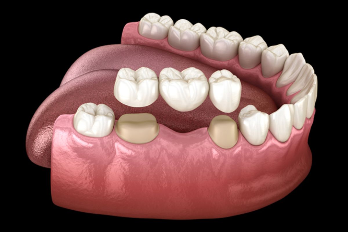 phương pháp cầu răng xứ