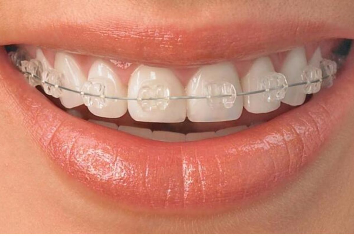Chỉnh nha bằng mắc cài composite