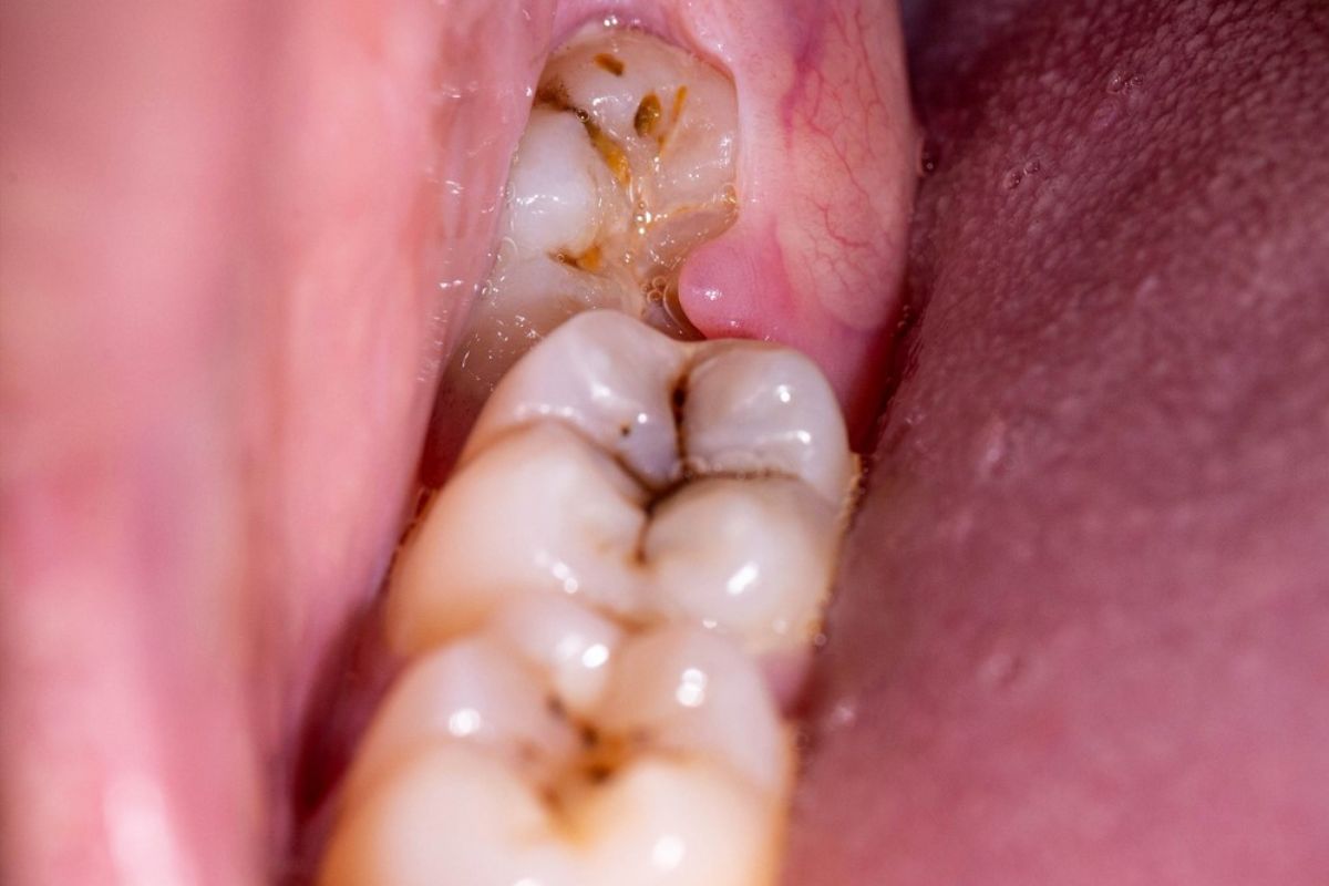 dấu hiệu nguy hiểm của răng khôn