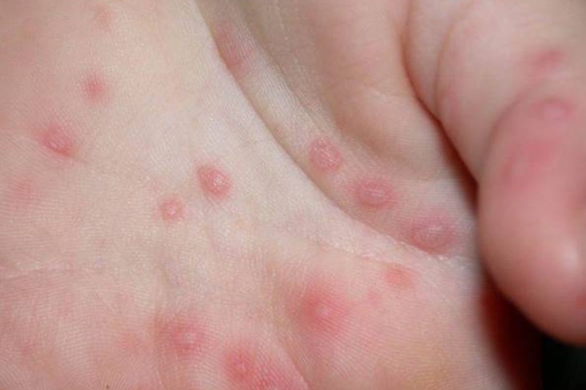 dấu hiệu tay chân miệng ở trẻ em
