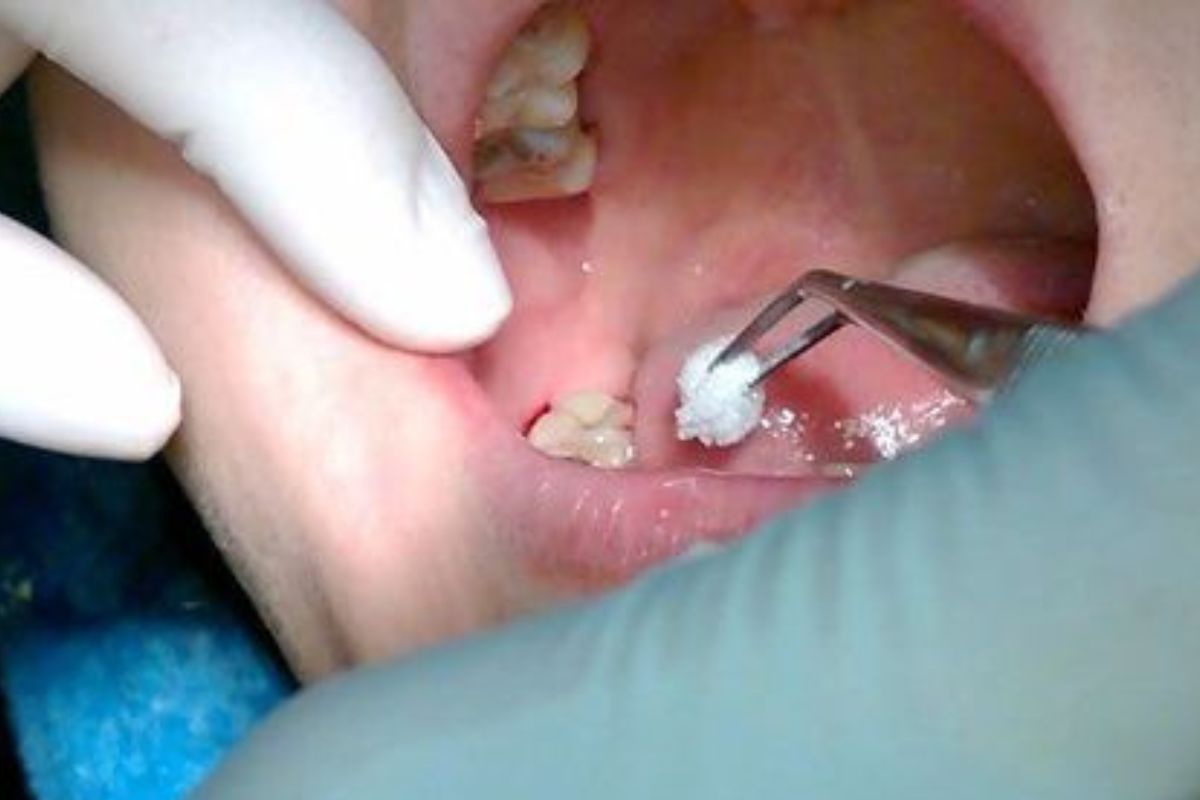 trường hợp cần nhổ răng khôn