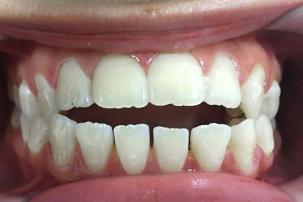 lệch khớp cắn là gì