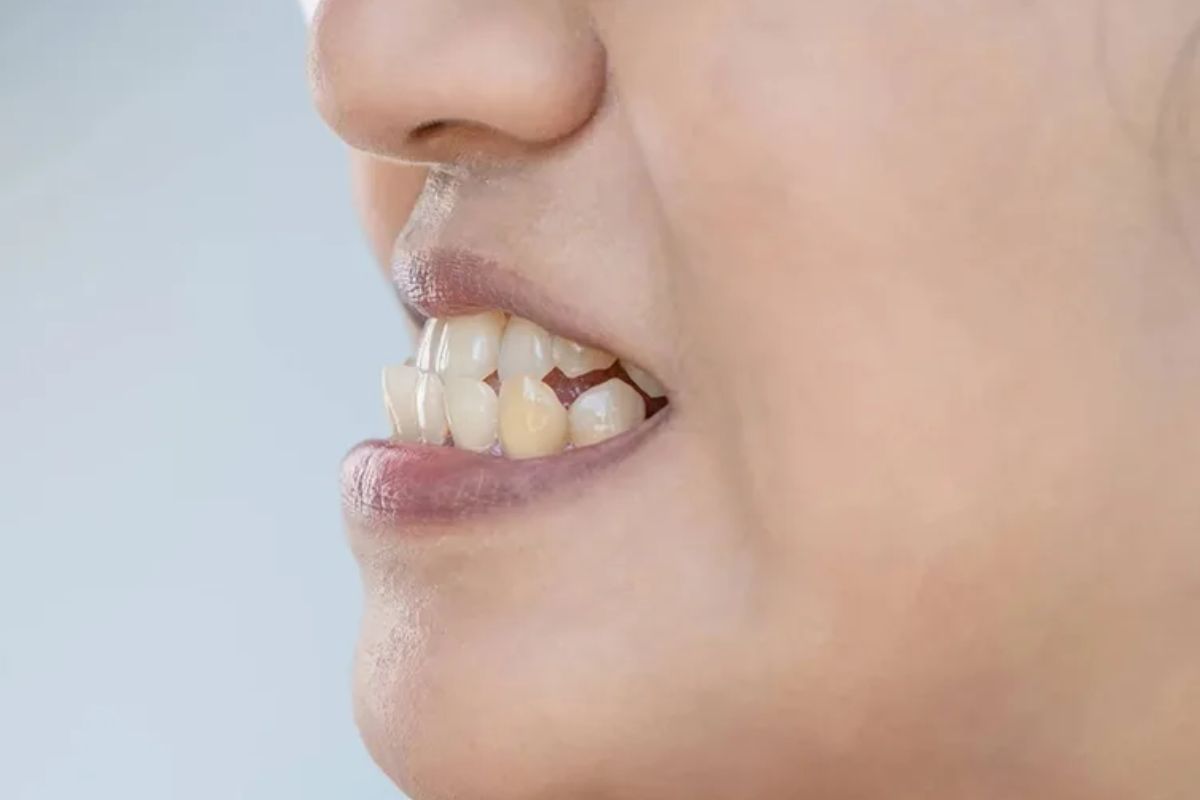 nguyên nhân bị răng móm