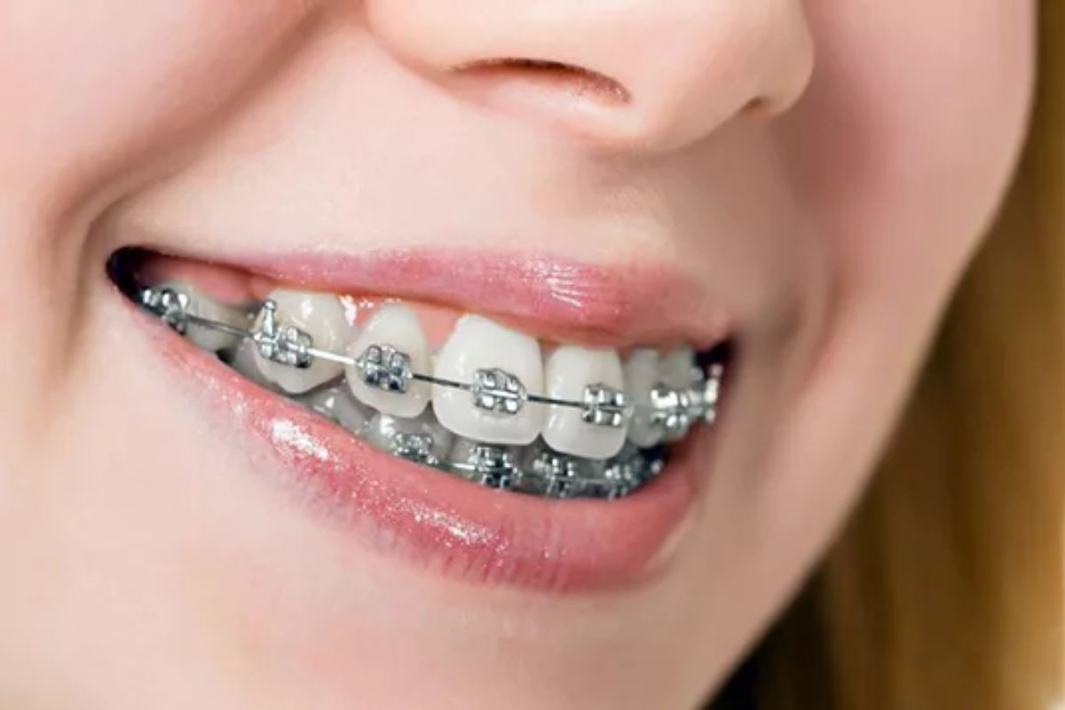 Niềng răng mắc cài kim loại