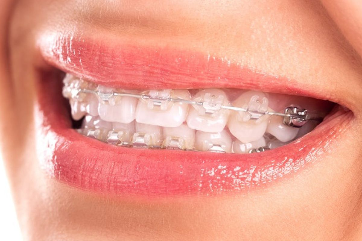 Niềng răng mắc cài sứ