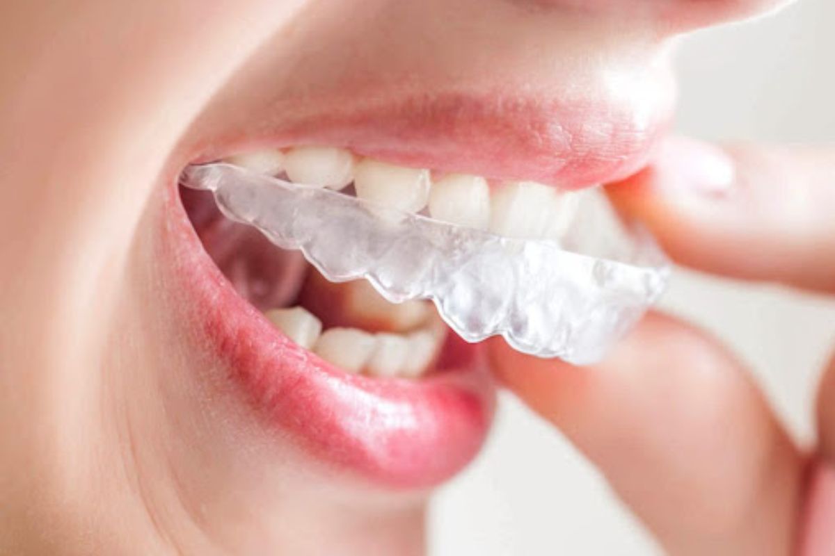 Niềng răng trong suốt Invisalign