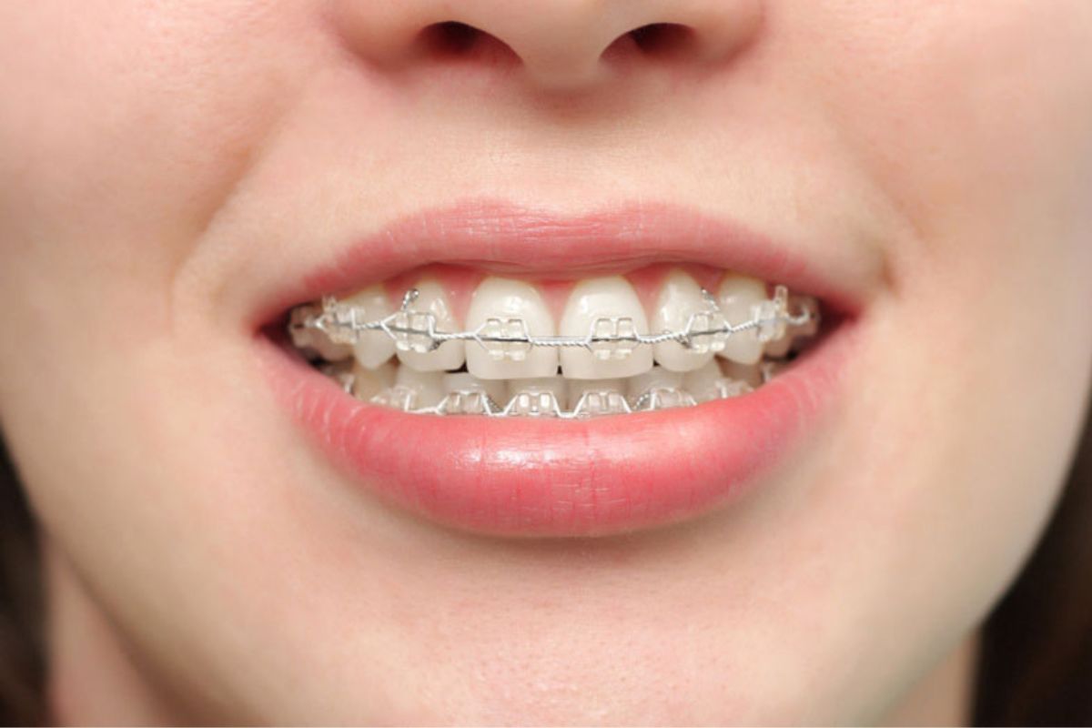 cách cải thiện răng móm