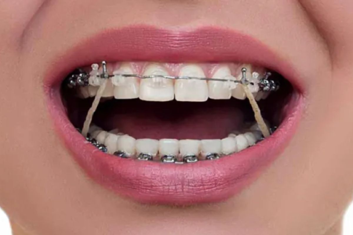 phương pháp cải thiện lệch khớp cắn