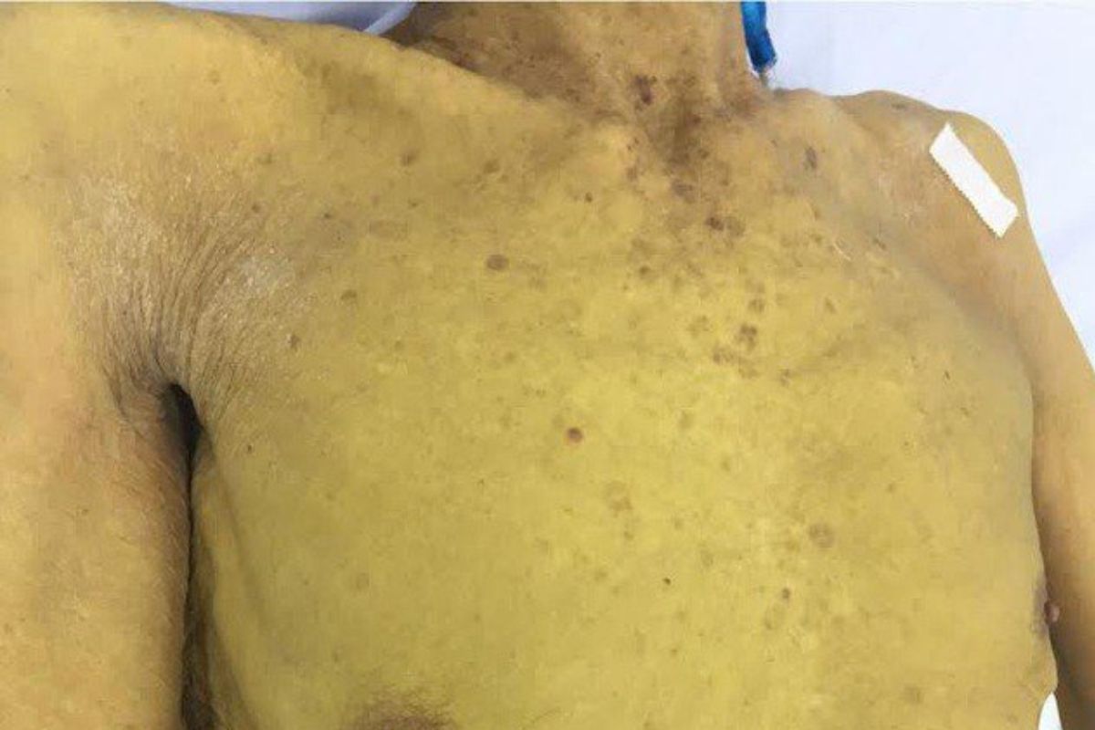 xơ gan có nguy hiểm không